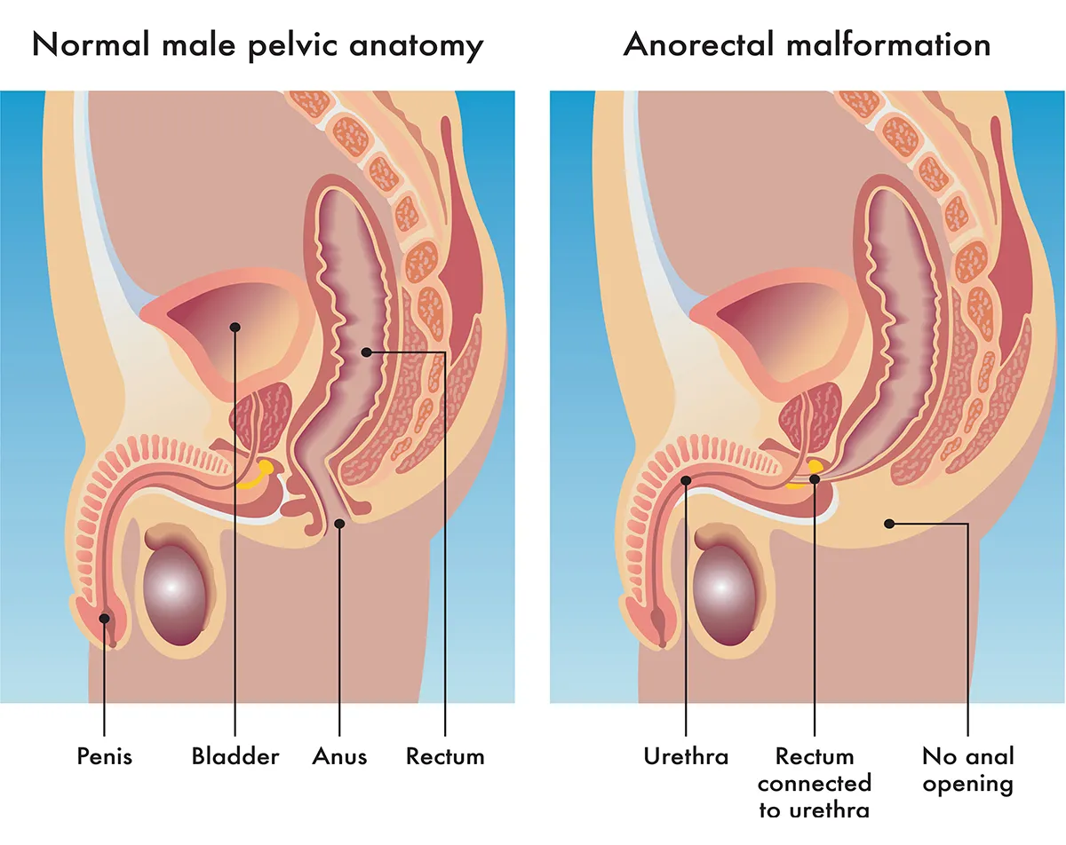 Image shows the difference between a normal male rectum and anus and an anorectal malformation where there is no anal opening and the rectum is connected to the male urethra.