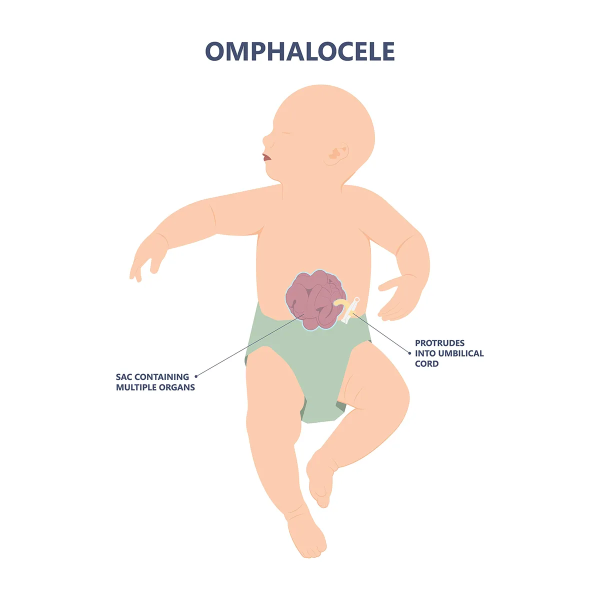 The image shows a baby with organs covered by a sac and sticking outside the body through the belly button.