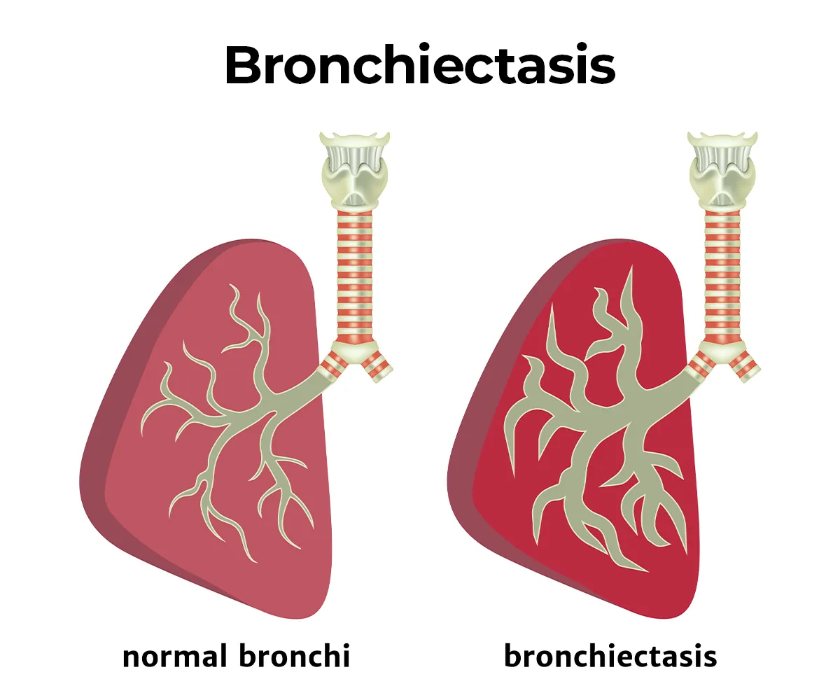 Illustration comparing normal bronchi in the lungs on the left to bronchi affected by bronchiectasis on the right, where the airways are abnormally widened and damaged.