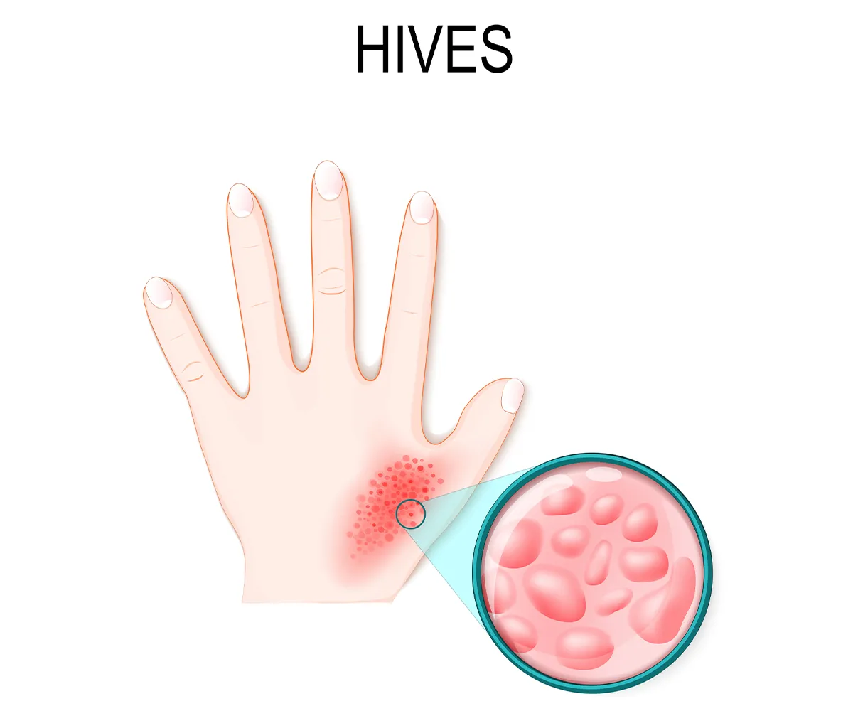 Image of a hand with hives, displaying red, raised welts typical of urticaria. A close-up shows the detailed texture of the skin rash.
